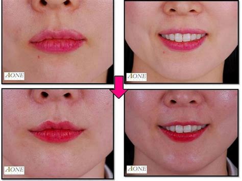 lip lift surgery korea